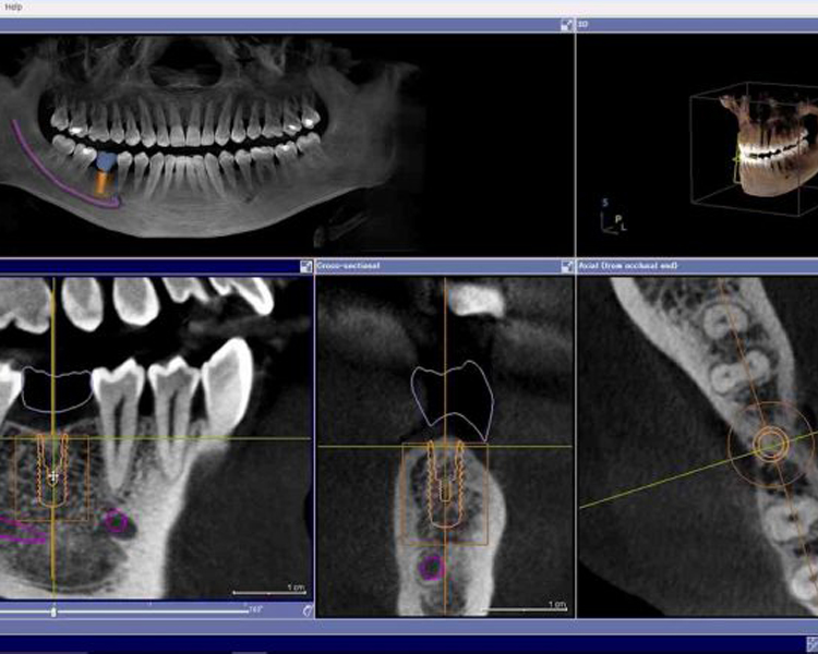 正確なインプラント治療のためにCTスキャナー＋3D画像診断・サージカルガイドを導入