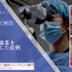 前歯の歯茎を増成した症例。