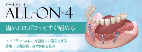 All-on-4