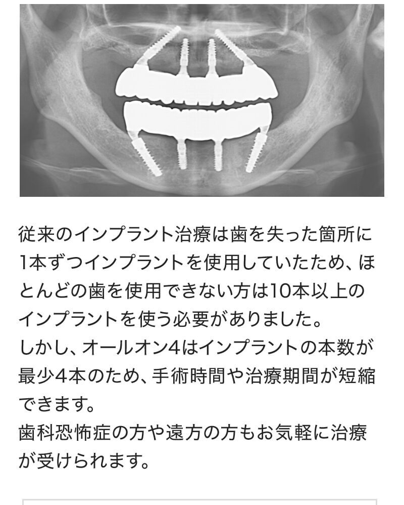 All-on-4（オール・オン・フォー）